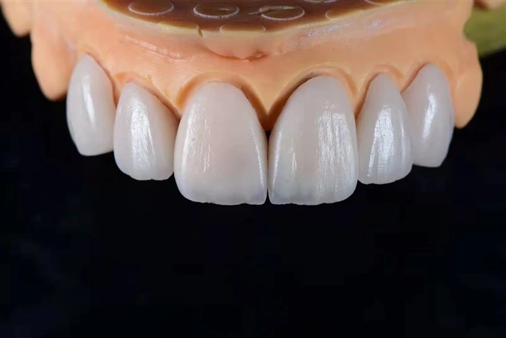 Veinírí Sraitheanna E.max Le Tréshoilseacht Incisal