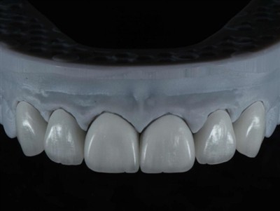 Conas Obair Thar Lear a Fhoinsiú do Theicneoir Saotharlainne Fiaclóireachta: ...