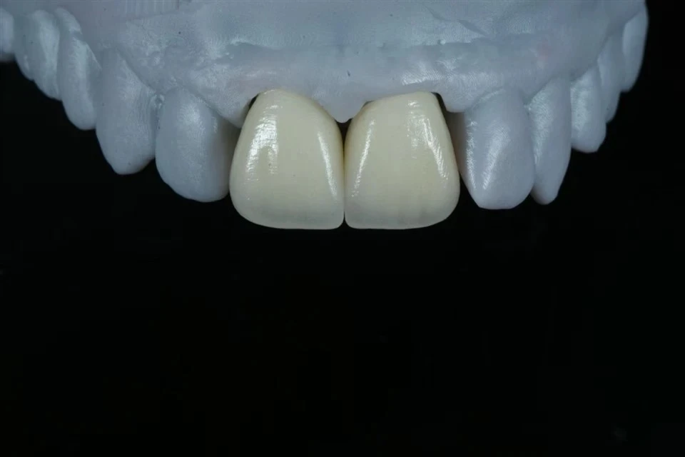 Zirconia Crowns For Anterior Teeth Zirconia Crowns For Anterior Teeth