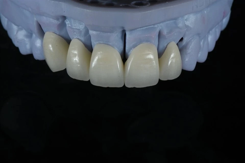 4Y/5Y Zirconia Crowns 4Y/5Y Zirconia Crowns