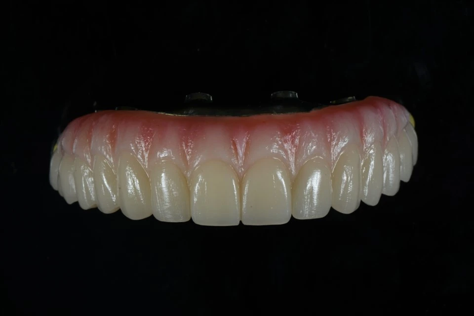 Maxillary Uile-ar-X Droichead Zirconia