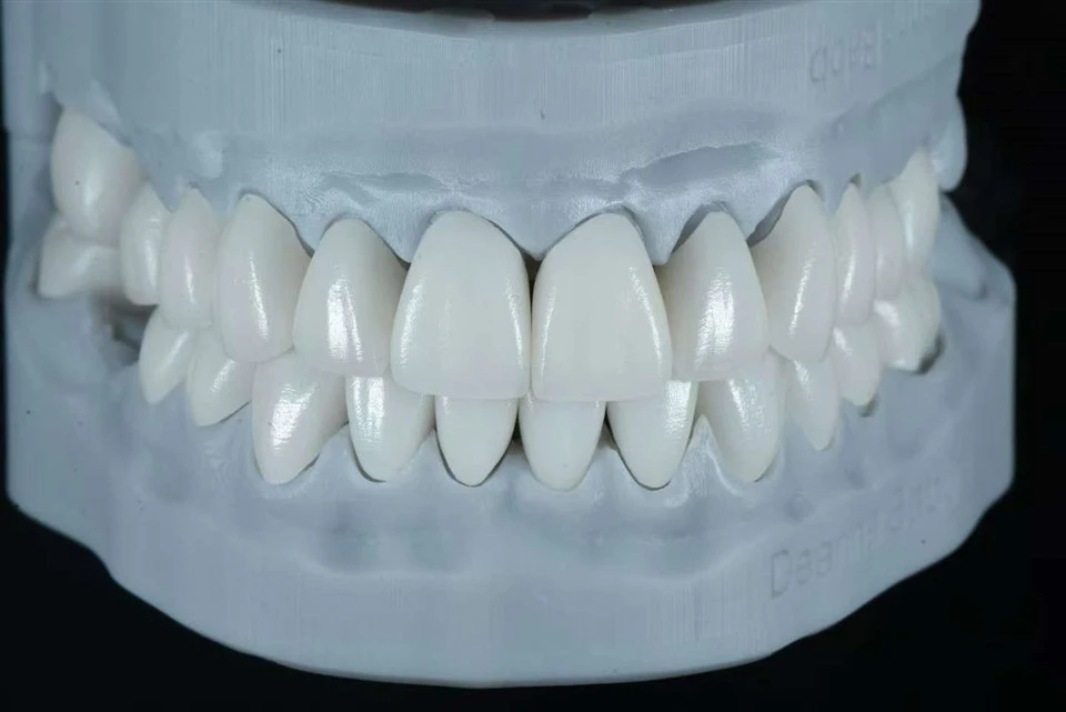 Íosráta-Prep E.max Layering Veneers