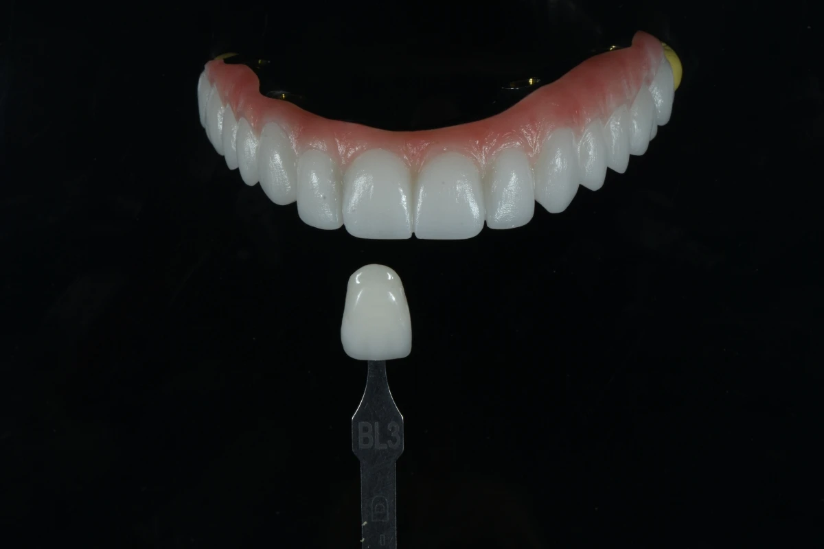 Full-arch zirconia bridge with customized gingival shade, contour and characterization Full-arch zirconia bridge with customized gingival shade, contour and characterization