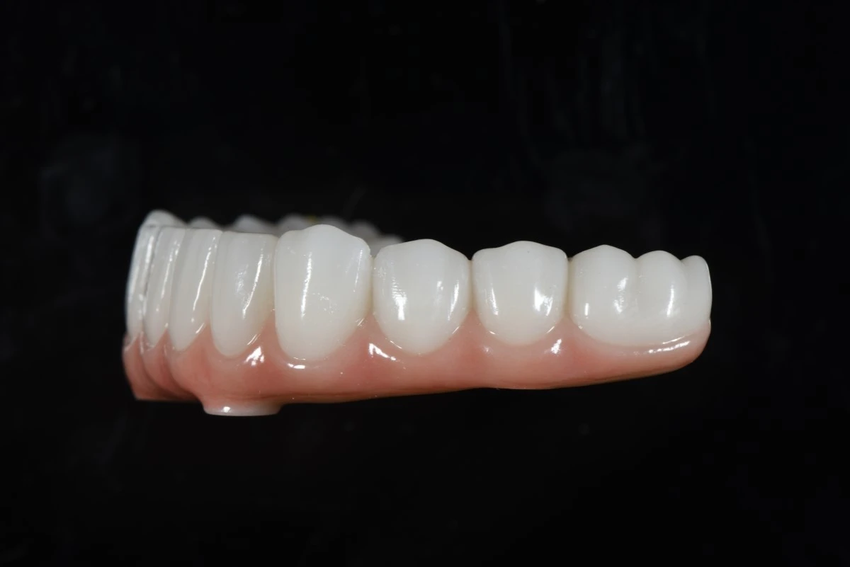 Mandibular All-on-X zirconia bridge showing lower-arch tooth arrangement and gingival transition Mandibular All-on-X zirconia bridge showing lower-arch tooth arrangement and gingival transition