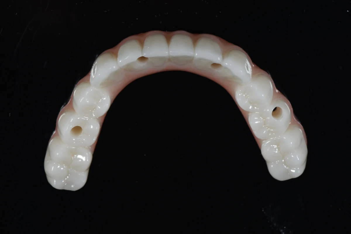 Occlusal view of mandibular All-on-X zirconia bridge with multiple screw access channels and full-arch design Occlusal view of mandibular All-on-X zirconia bridge with multiple screw access channels and full-arch design