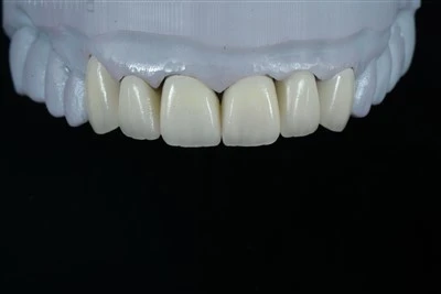 Veneers Sraitheanna E.max Anterior