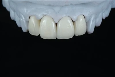 Ceithre{0}Aonad Maxillary Veinírí Sraitheanna Anterior E.max