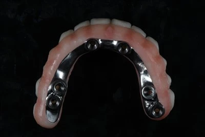 Scriú-Coimeádtha Uile-ar-X Zirconia Bridge