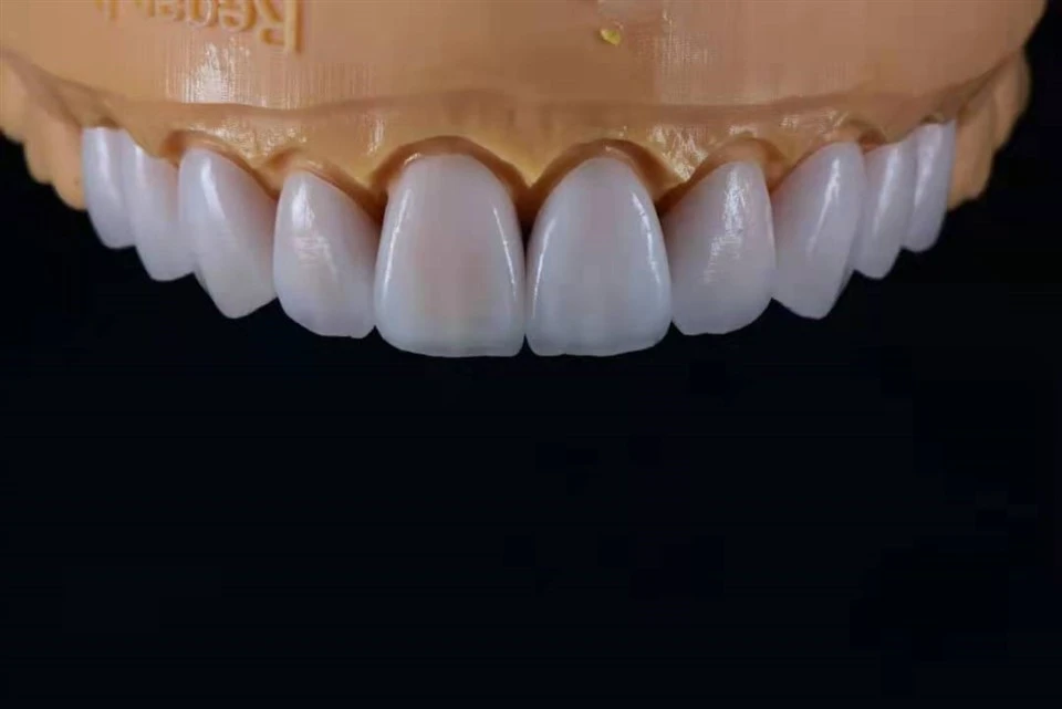 Ultra{0}}Veneers Sraitheanna tanaí E.max